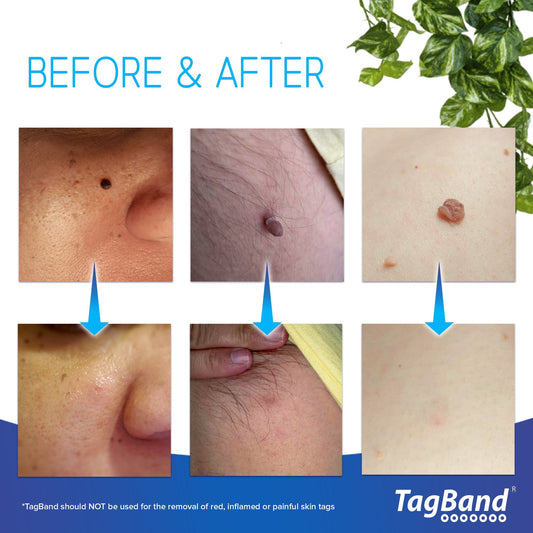 TagBand Skin Tag Removal